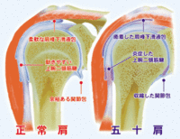 痛いだけではない「五十肩」