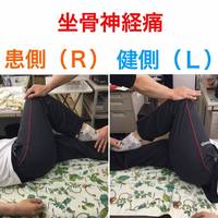 二種類ある坐骨神経痛