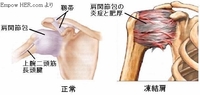 笠岡市へ出張整体・鍼灸～五十肩の改善～